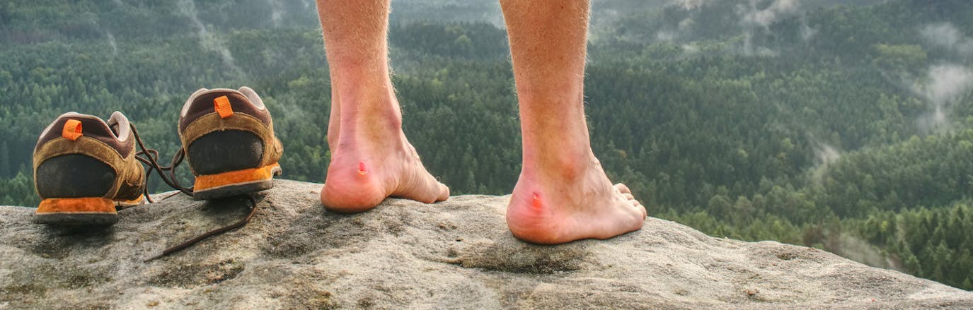 A man with blisters on his feet 